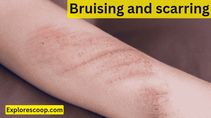How do i Care for Wound after Cyst Removal: 5 Steps Complete Guide 5 sings of brusing and scarring after cyst
