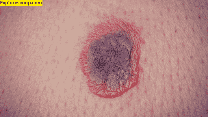 How do i Care for Wound after Cyst Removal: 5 Steps Complete Guide 1 a cyst on the skin