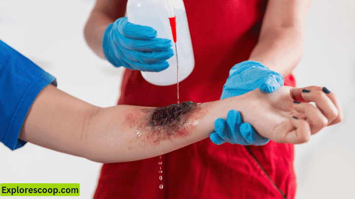 A burnt arm getting first aid(First Aid for kitchеn Accidеnts 7 Essеntials)