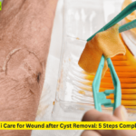 A cyst wond is being treated