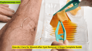A cyst wond is being treated