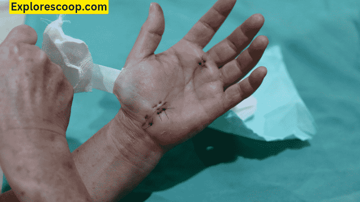 How do i Care for Wound after Cyst Removal: 5 Steps Complete Guide 3 dressing from wound is removed