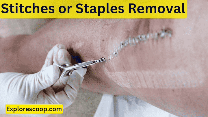 How do i Care for Wound after Cyst Removal: 5 Steps Complete Guide 6 removing stiches or staples