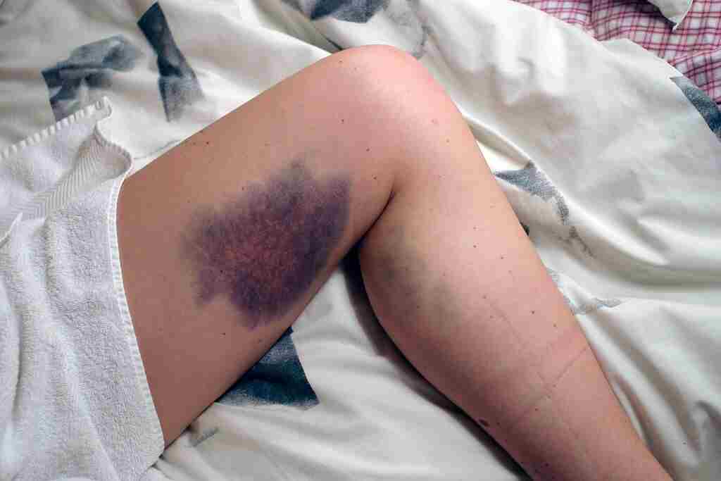 Thigh bruise recovery time 1 An image showing bruise on thigh-thigh bruise recovery time