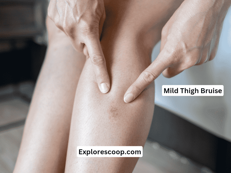 Thigh bruise recovery time 2 An image of mild thigh bruise- (thigh bruise recovery time)