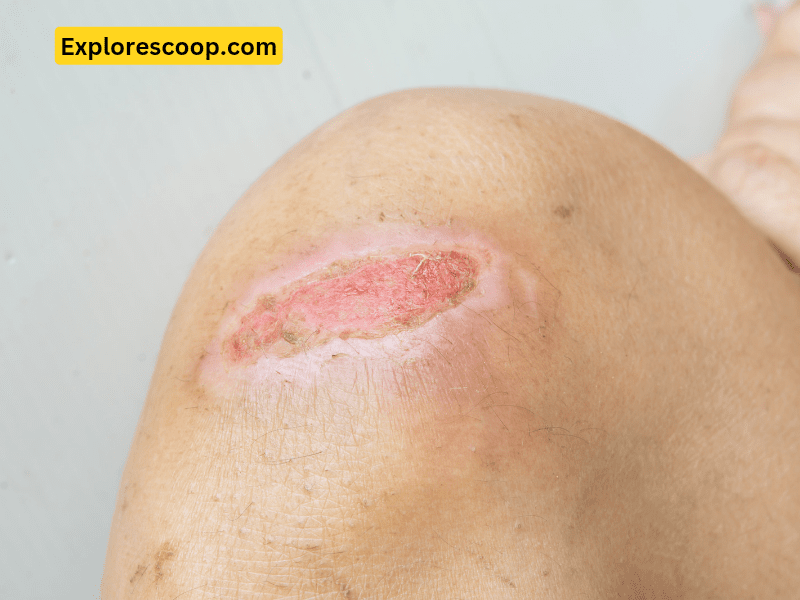 Why does my wound itch? 3 An image of wound-(why does my wound itch)